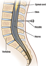 Position of needle for epidural block