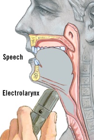 Illustration of an artificial larynx