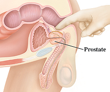 Cross section side view of male pelvis. Healthcare provider's gloved finger is inserted in rectum to feel prostate through rectal wall.