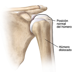 Vista frontal de un hombro dislocado.